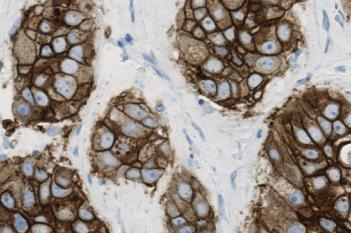 HER2 APP, Breast Cancer