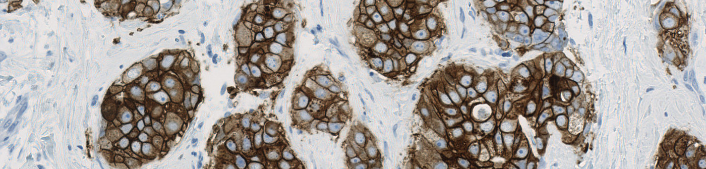 HER2 APP, Breast Cancer