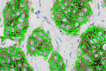 HER2 APP, Breast Cancer