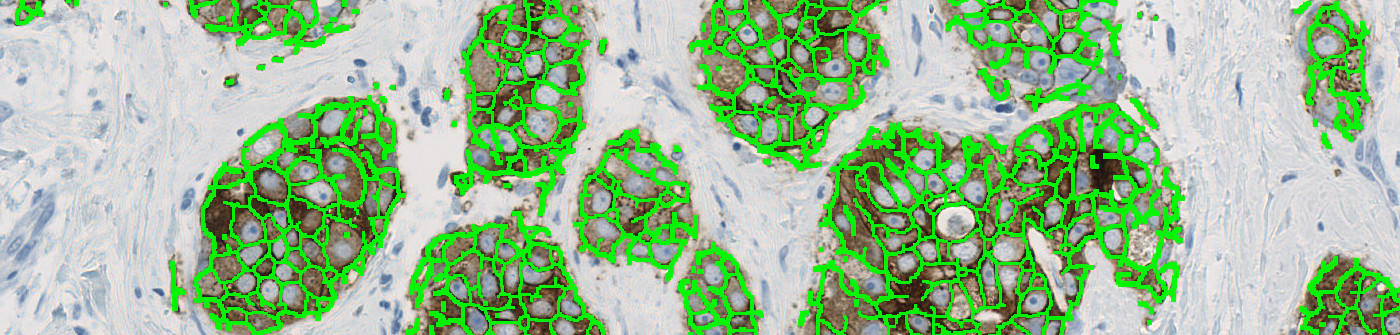 HER2 APP, Breast Cancer