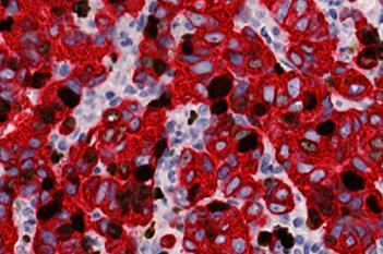 Ki-67+PanCK, Breast Cancer