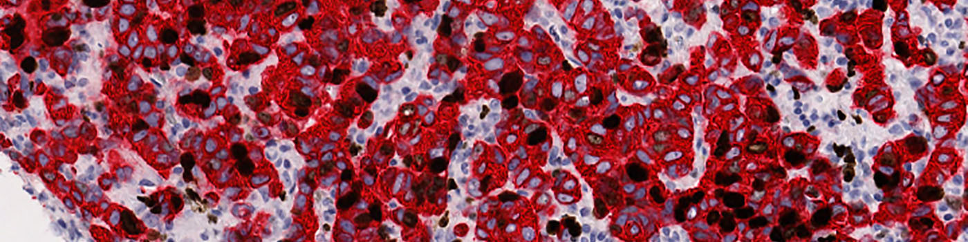 Ki-67+PanCK, Breast Cancer