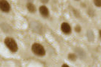 Annexin 10, Bladder Cancer