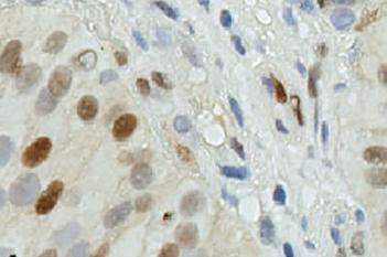 CyclinD1, Bladder Cancer