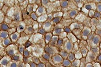 TRIM29, Bladder Cancer