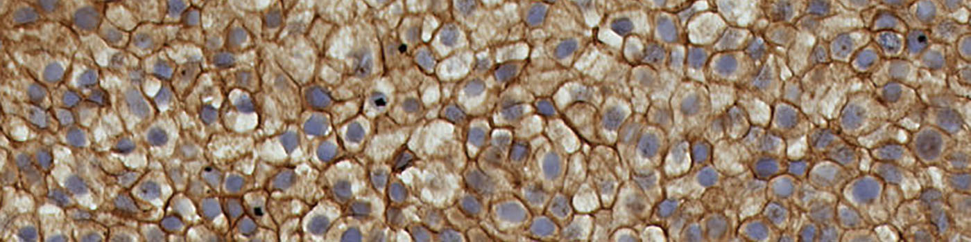 TRIM29, Bladder Cancer