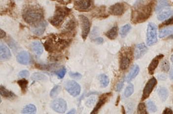 UBE2C, Bladder Cancer