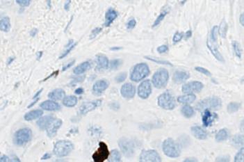 PHH3+PCK, Breast Cancer