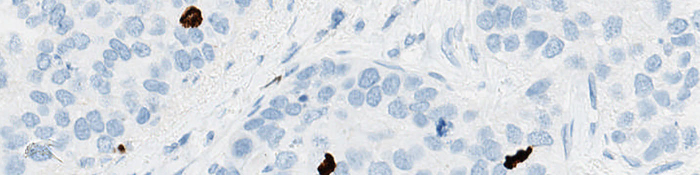 PHH3+PCK, Breast Cancer