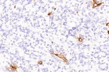 CD31, Tumor Neovascularization