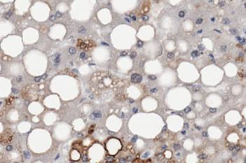 Adipophilin, Fatty Liver Disease