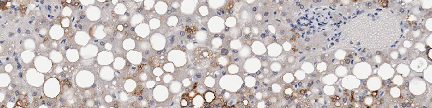 Adipophilin, Fatty Liver Disease