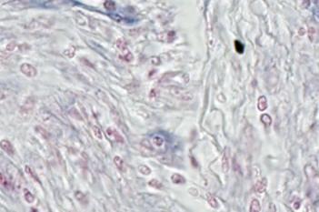 miR-126, Colon Cancer