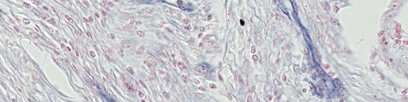 miR-126, Colon Cancer