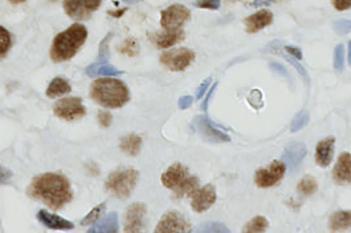 MCM7, Bladder Cancer