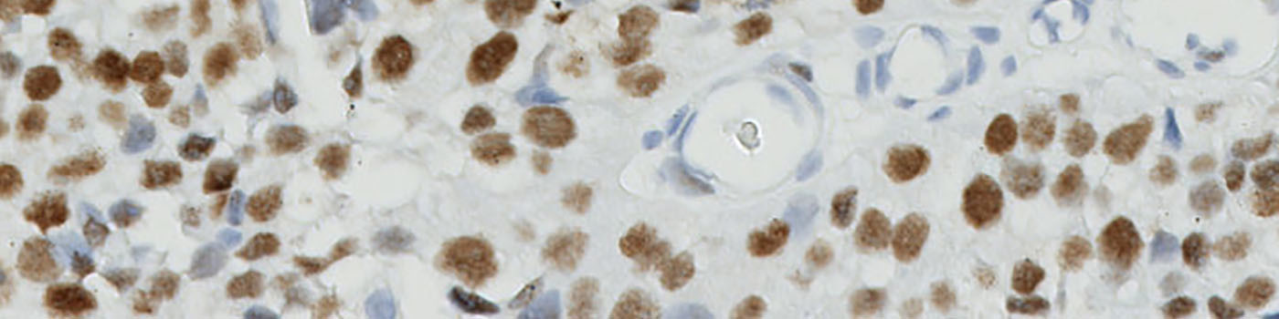 MCM7, Bladder Cancer