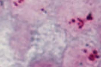 HER2-CISH, Breast Cancer