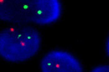 HER2-FISH, Breast Cancer