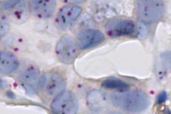 HER2-SISH, Breast Cancer