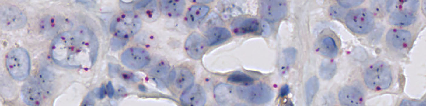 HER2-SISH, Breast Cancer