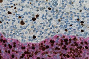 Ki-67+p16, Cervical Cancer