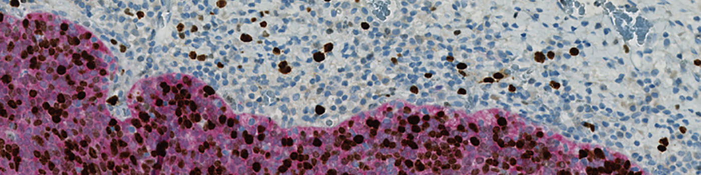 Ki-67+p16, Cervical Cancer