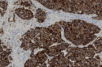 CK8/18, Breast Cancer