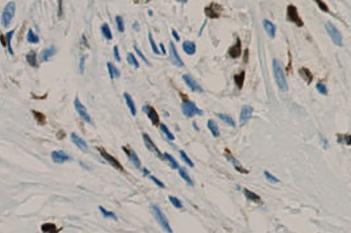 5LO, Arteriosclerosis