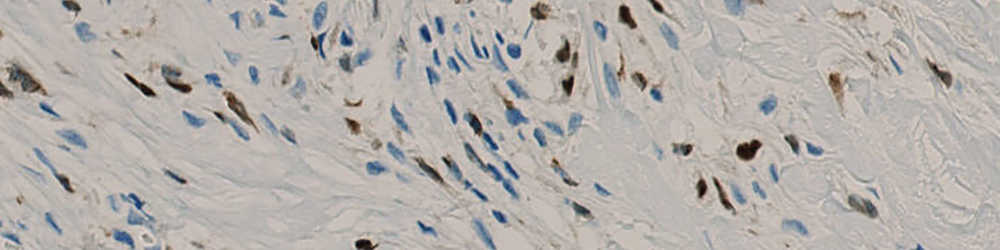 5LO, Arteriosclerosis