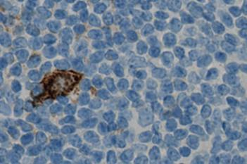CD15, Hodgkin's Lymphoma