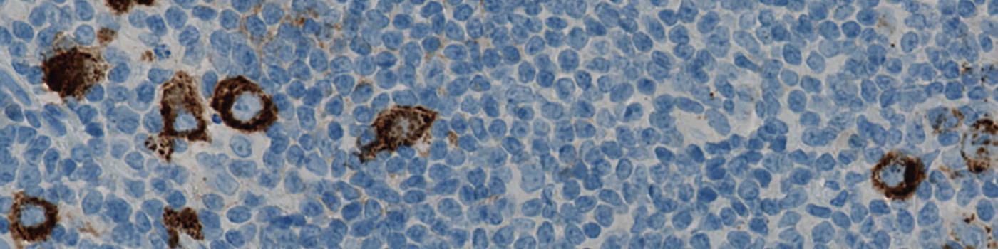 CD15, Hodgkin’s Lymphoma