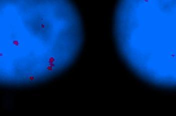 HER2/HER3, Breast Cancer