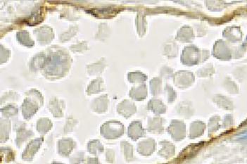 CD31+CD34, Kidney Cancer