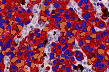 Ki-67+PanCK, Breast Cancer