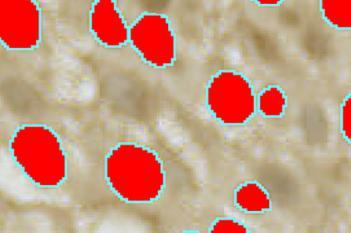 Annexin 10, Bladder Cancer