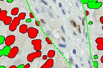 CyclinD1, Bladder Cancer