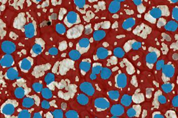 TRIM29, Bladder Cancer