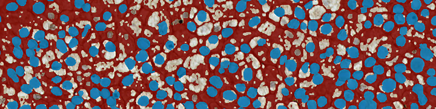 TRIM29, Bladder Cancer