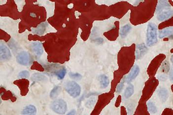 UBE2C, Bladder Cancer