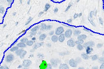 PHH3+PCK, Breast Cancer