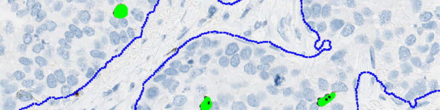 PHH3+PCK, Breast Cancer