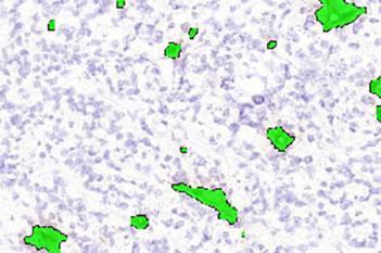 CD31, Tumor Neovascularization