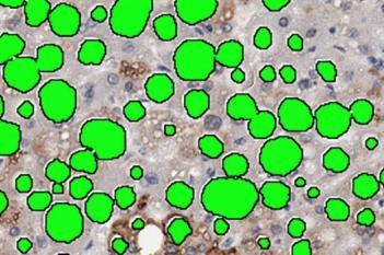 Adipophilin, Fatty Liver Disease