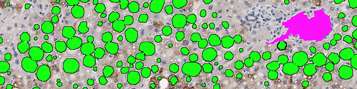 Adipophilin, Fatty Liver Disease