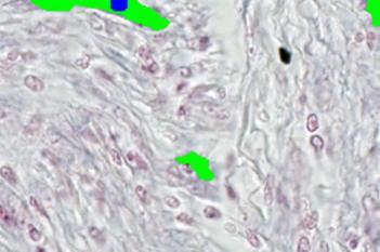 miR-126, Colon Cancer