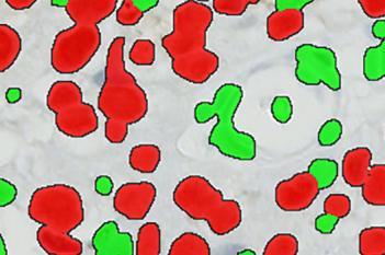 MCM7, Bladder Cancer