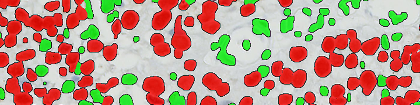 MCM7, Bladder Cancer