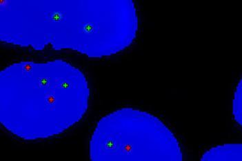 HER2-FISH, Breast Cancer