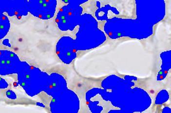 HER2-SISH, Breast Cancer