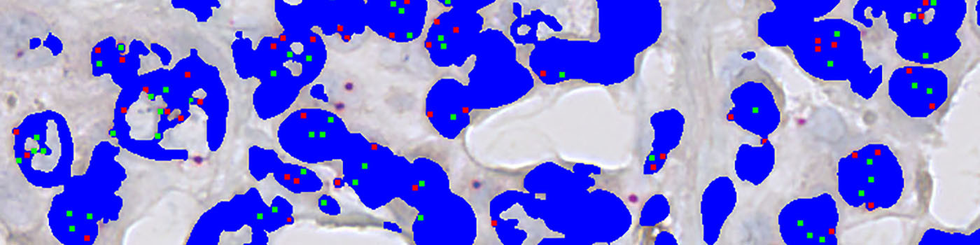 HER2-SISH, Breast Cancer